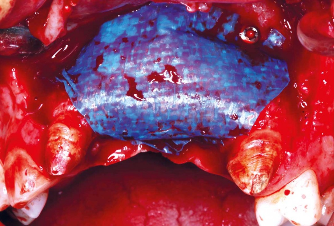 botiss-cerabone-permamem-maxgraft-mucoderm-horizontal-gbr-maghaireh