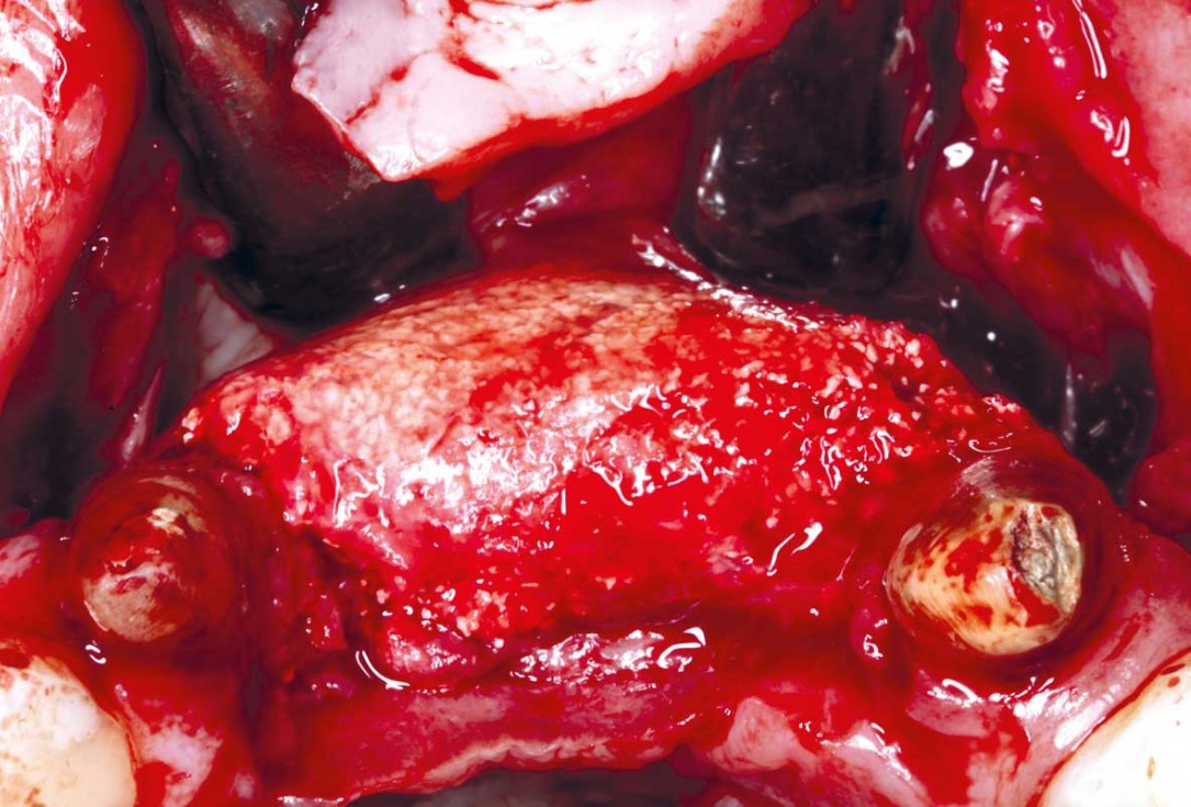 botiss-cerabone-permamem-maxgraft-mucoderm-horizontal-gbr-maghaireh