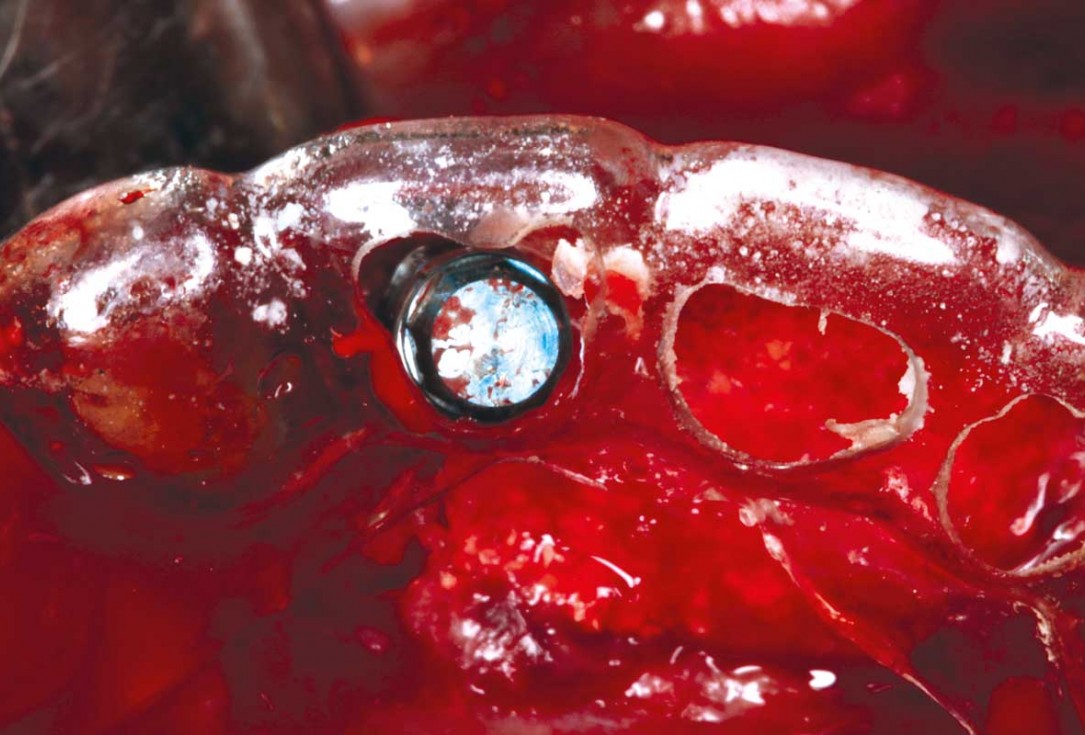 botiss-cerabone-permamem-maxgraft-mucoderm-horizontal-gbr-maghaireh