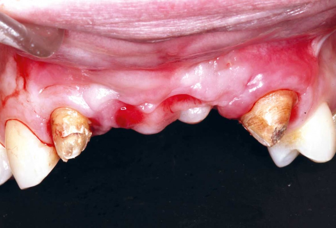 botiss-cerabone-permamem-maxgraft-mucoderm-horizontal-gbr-maghaireh