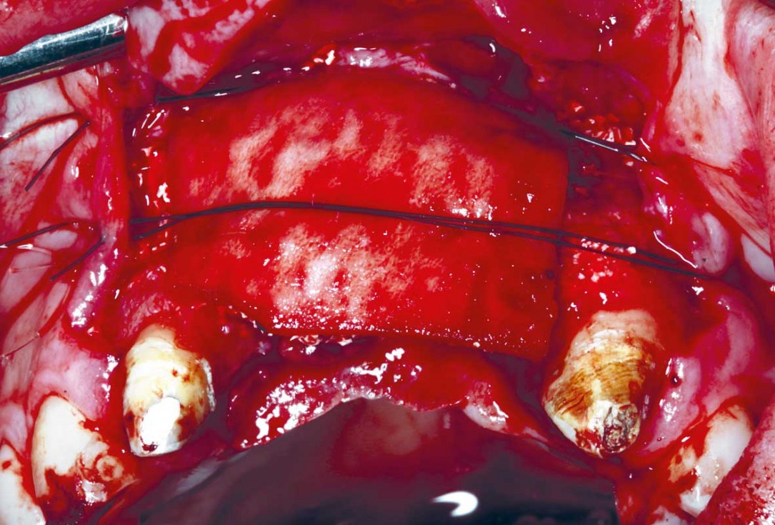 botiss-cerabone-permamem-maxgraft-mucoderm-horizontal-gbr-maghaireh