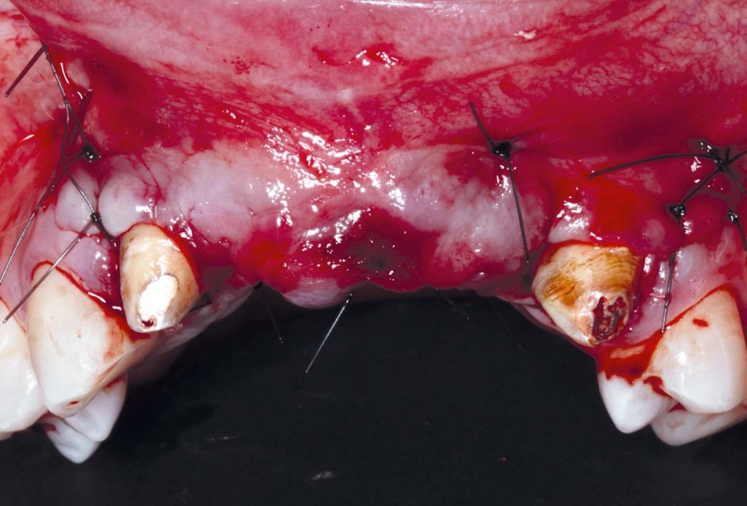 botiss-cerabone-permamem-maxgraft-mucoderm-horizontal-gbr-maghaireh