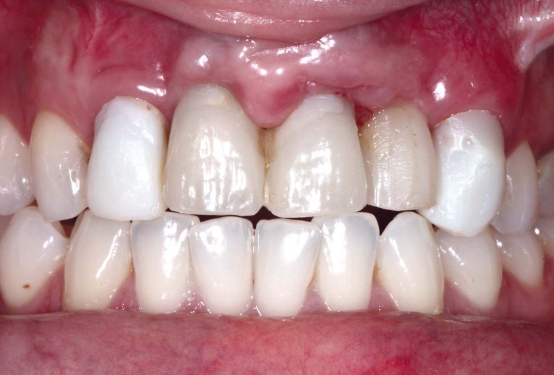 botiss-cerabone-permamem-maxgraft-mucoderm-horizontal-gbr-maghaireh