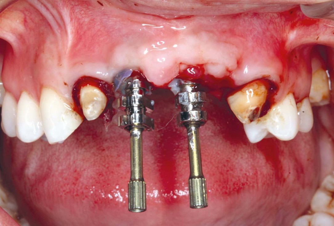botiss-cerabone-permamem-maxgraft-mucoderm-horizontal-gbr-maghaireh