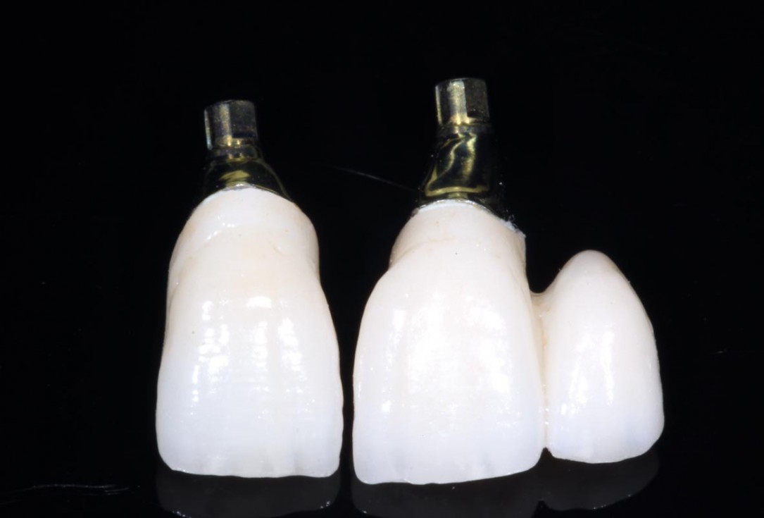 botiss-cerabone-permamem-maxgraft-mucoderm-horizontal-gbr-maghaireh