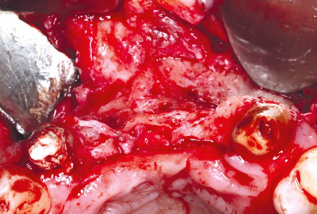 botiss-cerabone-permamem-maxgraft-mucoderm-horizontal-gbr-maghaireh