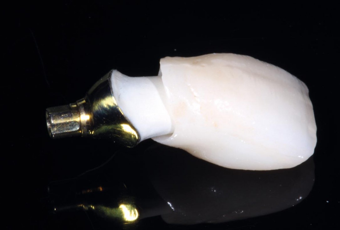 botiss-cerabone-permamem-maxgraft-mucoderm-horizontal-gbr-maghaireh