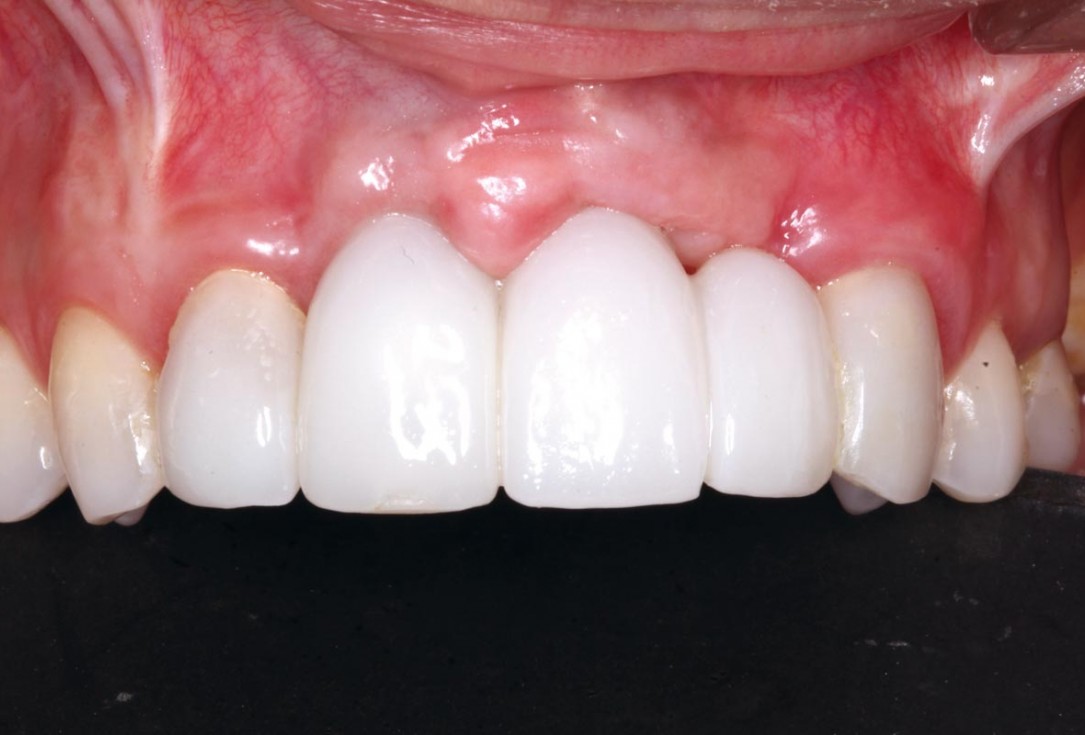 botiss-cerabone-permamem-maxgraft-mucoderm-horizontal-gbr-maghaireh