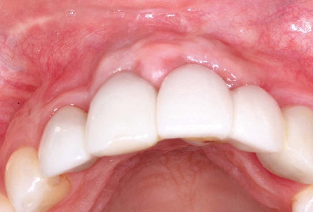 botiss-cerabone-permamem-maxgraft-mucoderm-horizontal-gbr-maghaireh