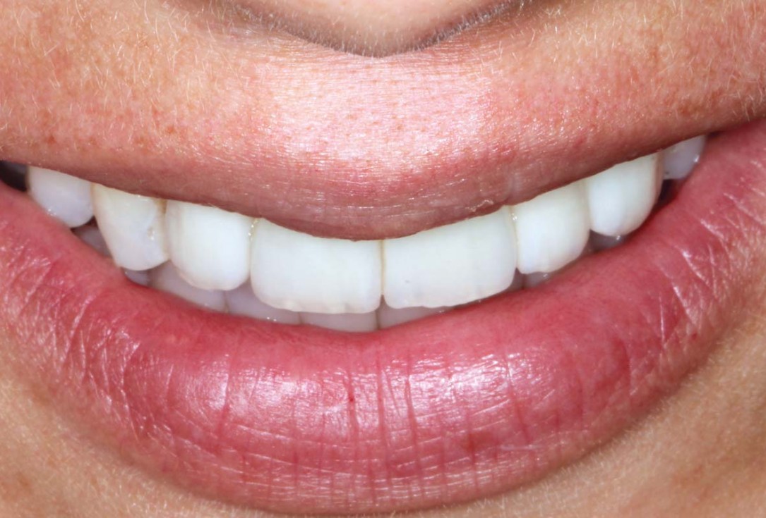 botiss-cerabone-permamem-maxgraft-mucoderm-horizontal-gbr-maghaireh