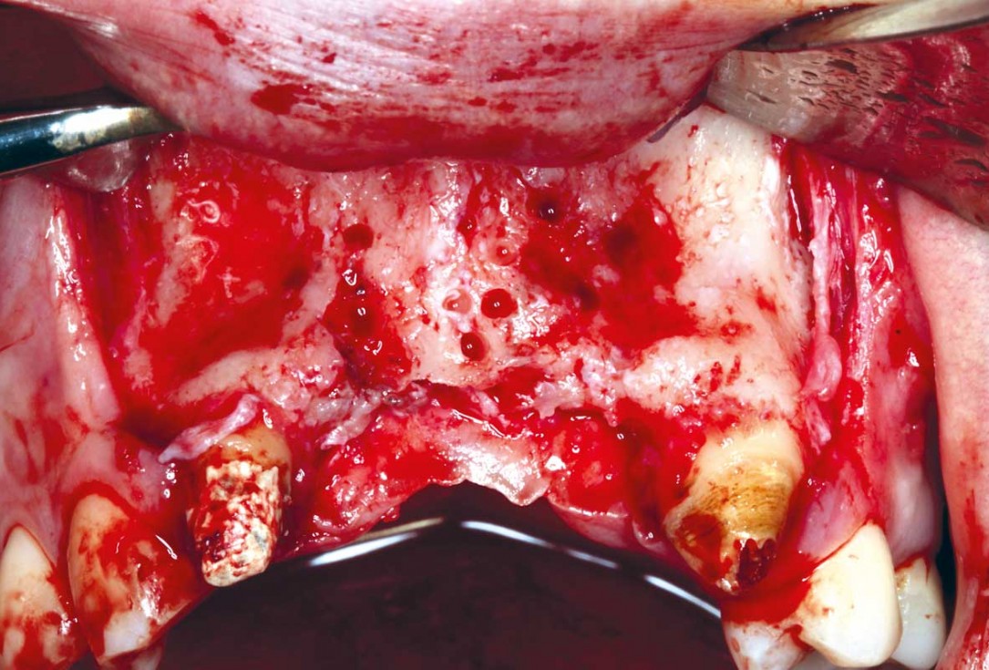 botiss-cerabone-permamem-maxgraft-mucoderm-horizontal-gbr-maghaireh