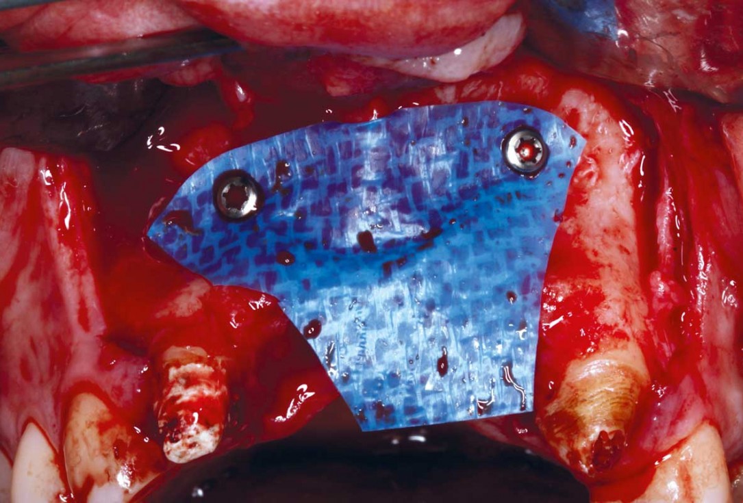 botiss-cerabone-permamem-maxgraft-mucoderm-horizontal-gbr-maghaireh