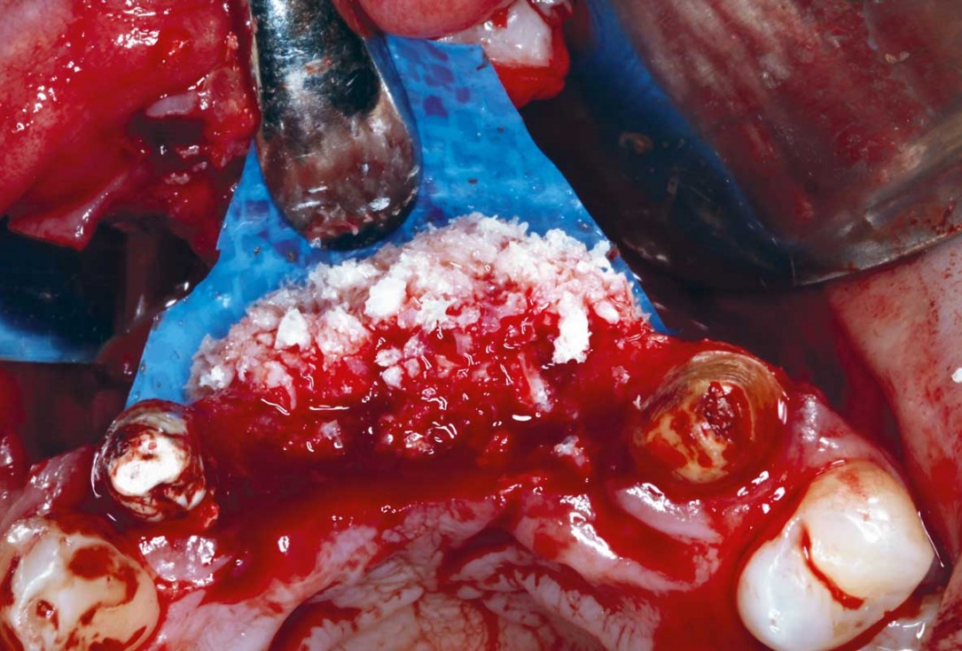 botiss-cerabone-permamem-maxgraft-mucoderm-horizontal-gbr-maghaireh