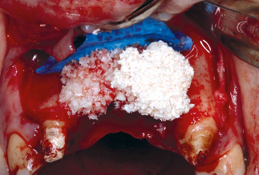 botiss-cerabone-permamem-maxgraft-mucoderm-horizontal-gbr-maghaireh