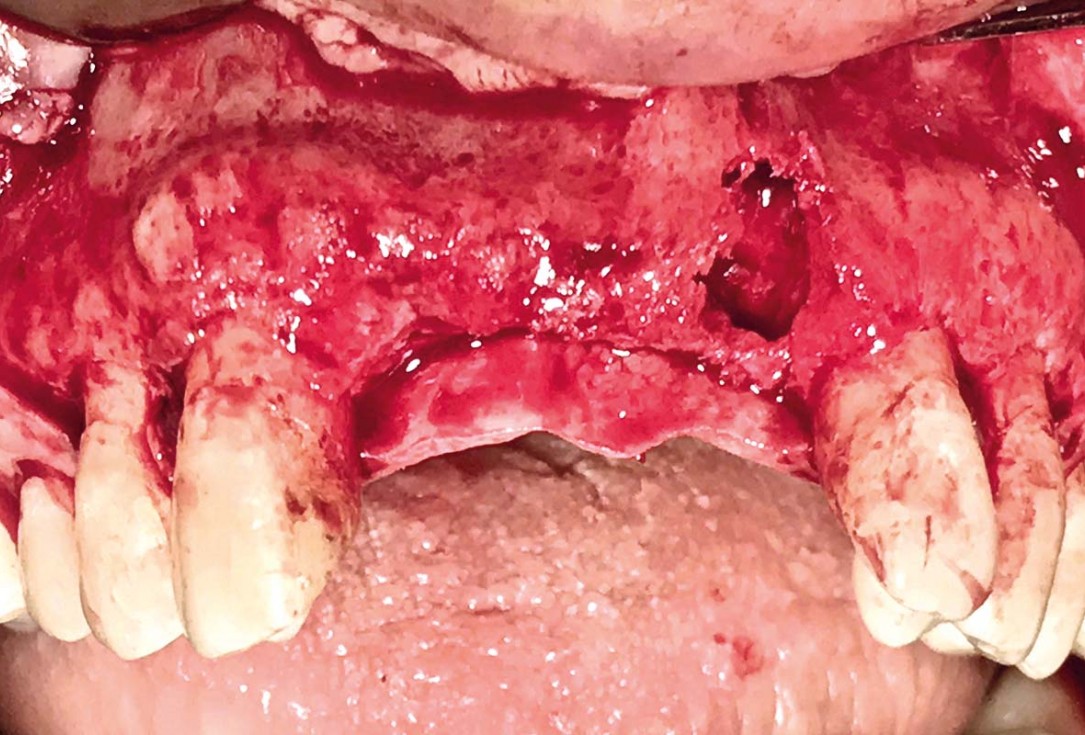 Implant placement and ridge augmentation using autologous bone, cerabone® and permamem® - Dr. I. Bellanco