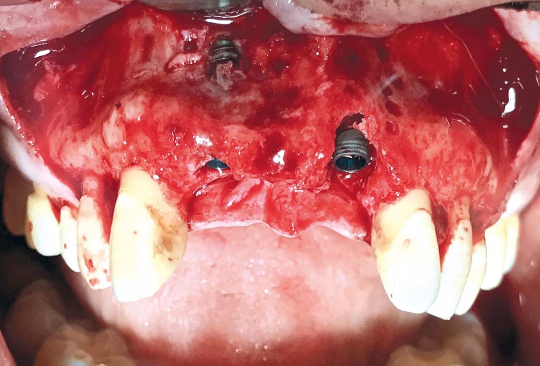 Implant placement and ridge augmentation using autologous bone, cerabone® and permamem® - Dr. I. Bellanco