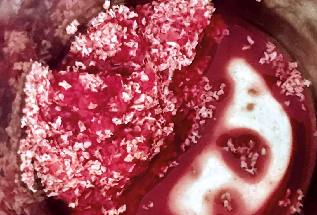 Implant placement and ridge augmentation using autologous bone, cerabone® and permamem® - Dr. I. Bellanco