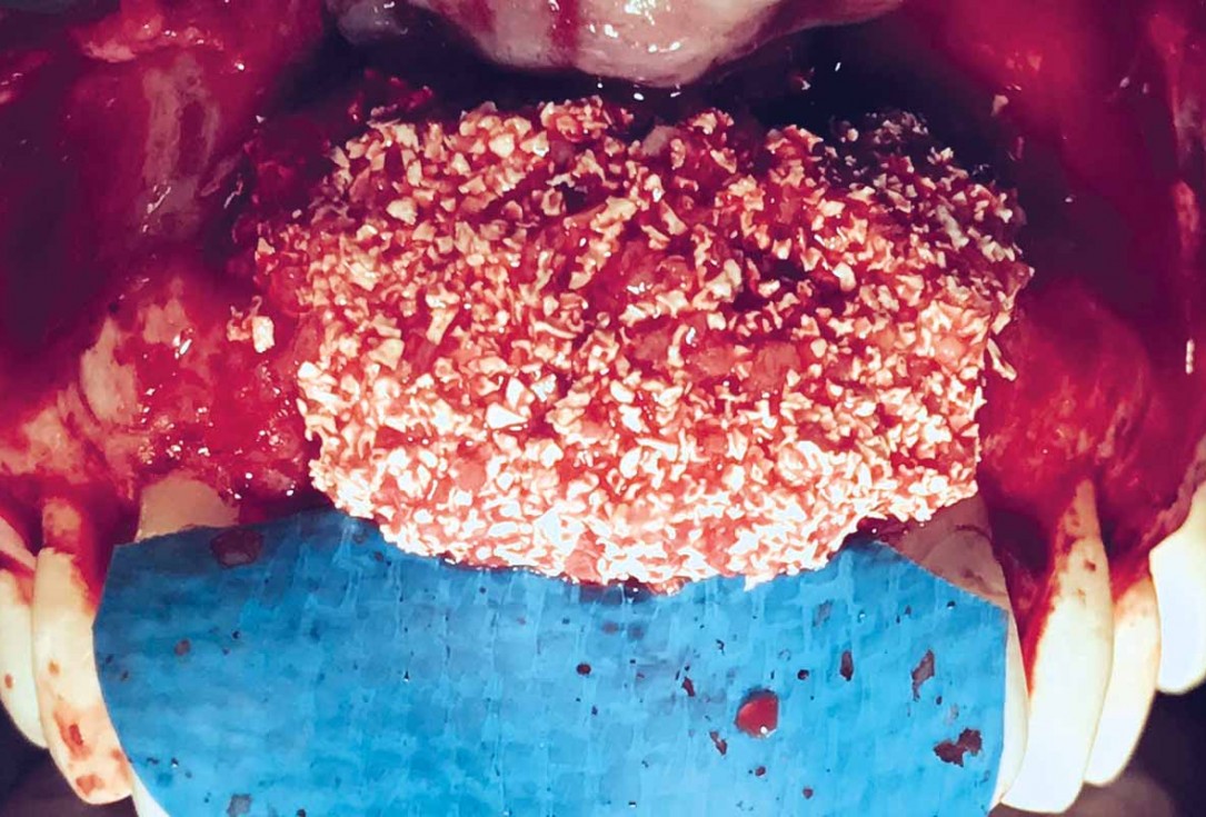 Implant placement and ridge augmentation using autologous bone, cerabone® and permamem® - Dr. I. Bellanco