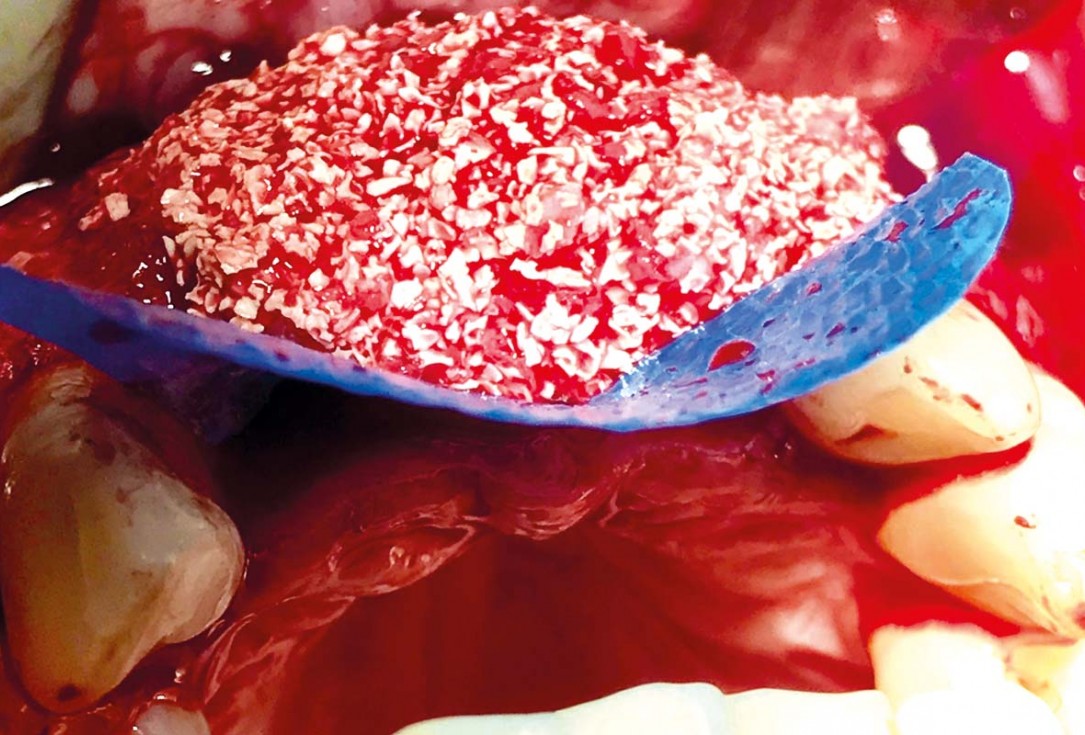 Implant placement and ridge augmentation using autologous bone, cerabone® and permamem® - Dr. I. Bellanco