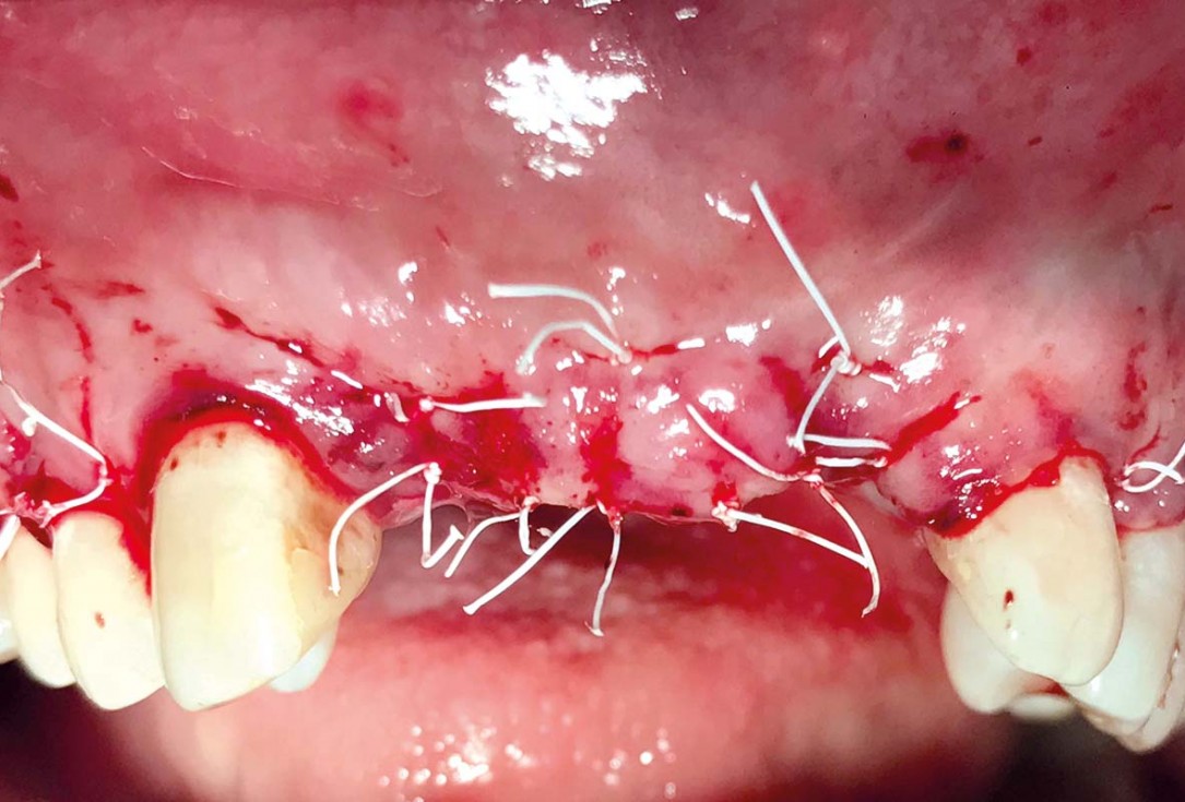 Implant placement and ridge augmentation using autologous bone, cerabone® and permamem® - Dr. I. Bellanco