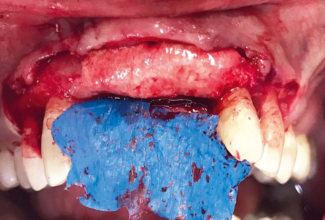 Implant placement and ridge augmentation using autologous bone, cerabone® and permamem® - Dr. I. Bellanco