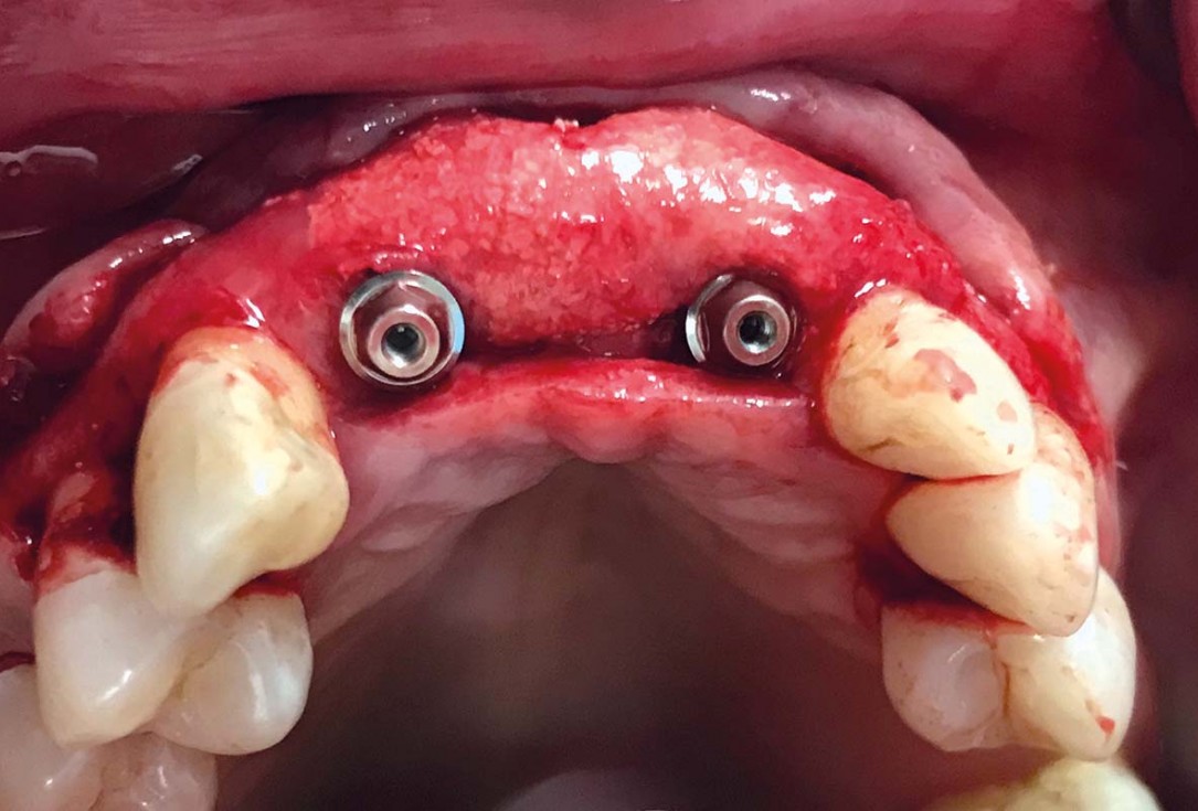 Implant placement and ridge augmentation using autologous bone, cerabone® and permamem® - Dr. I. Bellanco