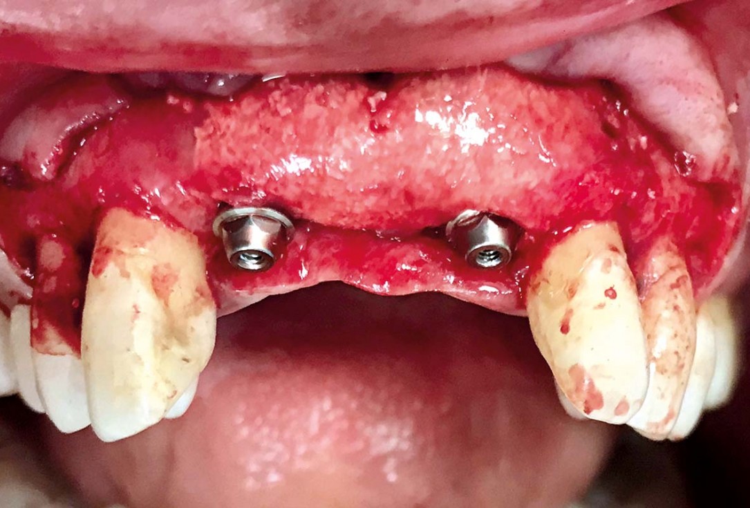Implant placement and ridge augmentation using autologous bone, cerabone® and permamem® - Dr. I. Bellanco