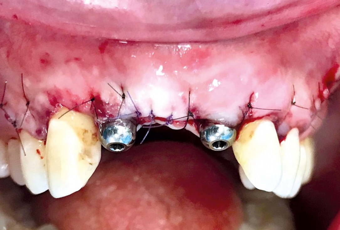 Implant placement and ridge augmentation using autologous bone, cerabone® and permamem® - Dr. I. Bellanco