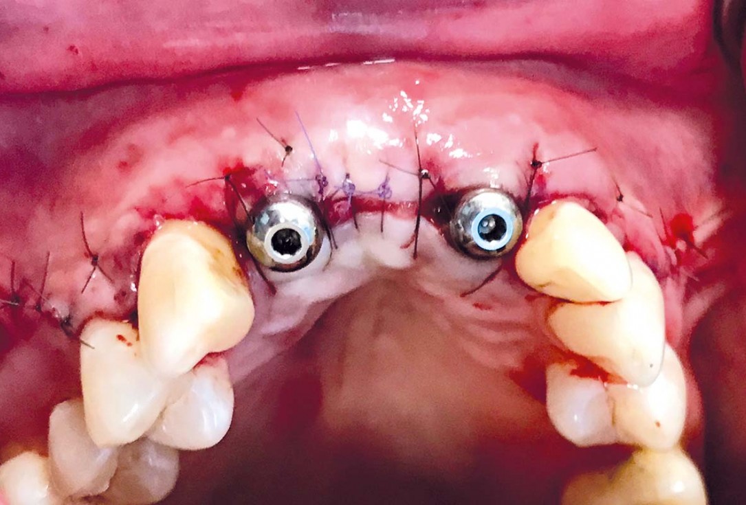 Implant placement and ridge augmentation using autologous bone, cerabone® and permamem® - Dr. I. Bellanco