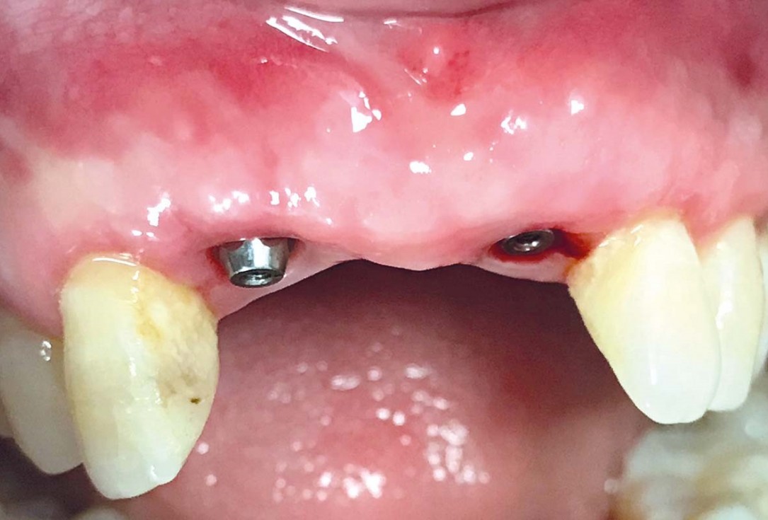 Implant placement and ridge augmentation using autologous bone, cerabone® and permamem® - Dr. I. Bellanco