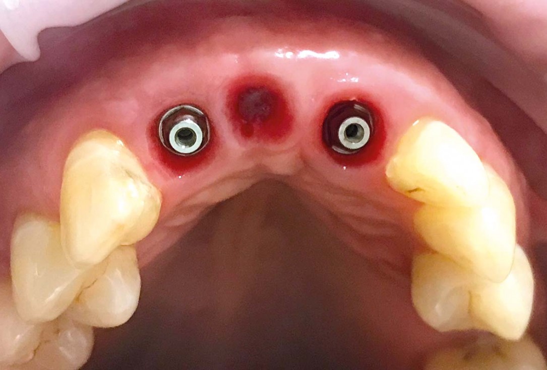 Implant placement and ridge augmentation using autologous bone, cerabone® and permamem® - Dr. I. Bellanco
