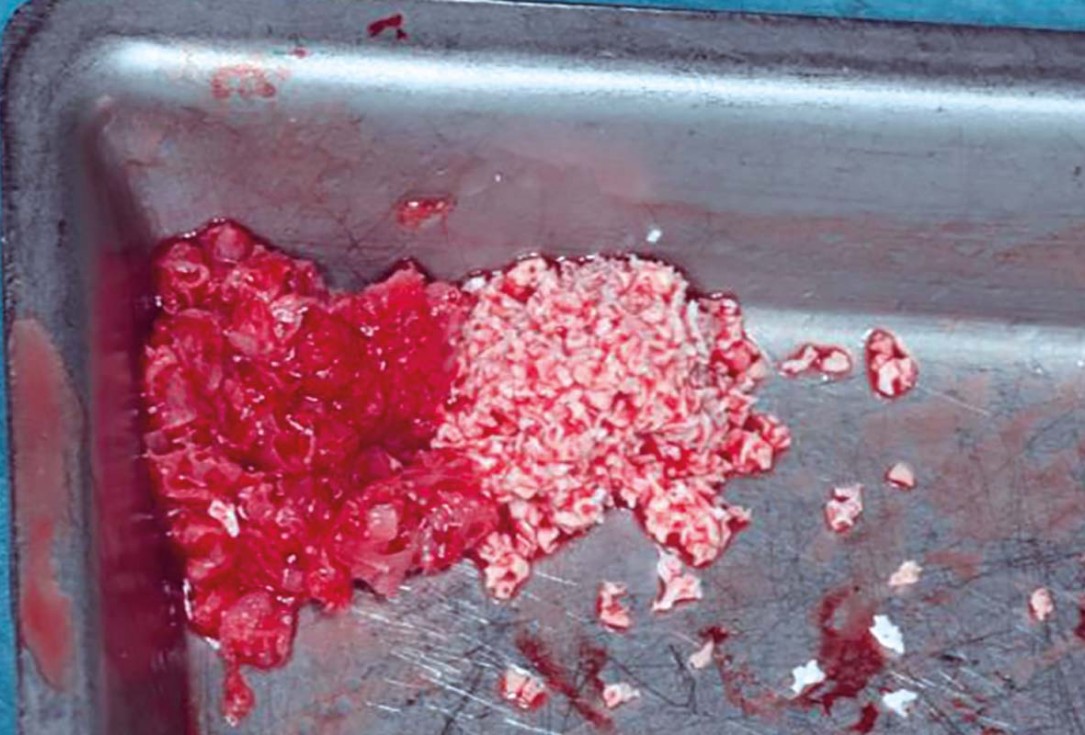 Horizontal GBR in the anterior mandible - Dr. B. Molnar