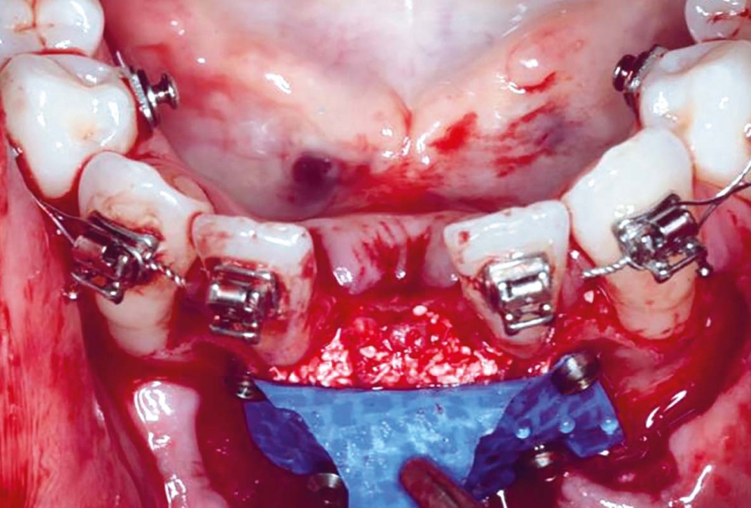 Horizontal GBR in the anterior mandible - Dr. B. Molnar