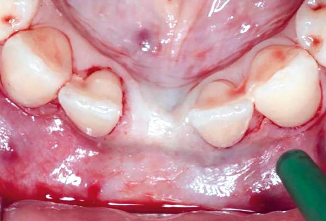 Horizontal GBR in the anterior mandible - Dr. B. Molnar