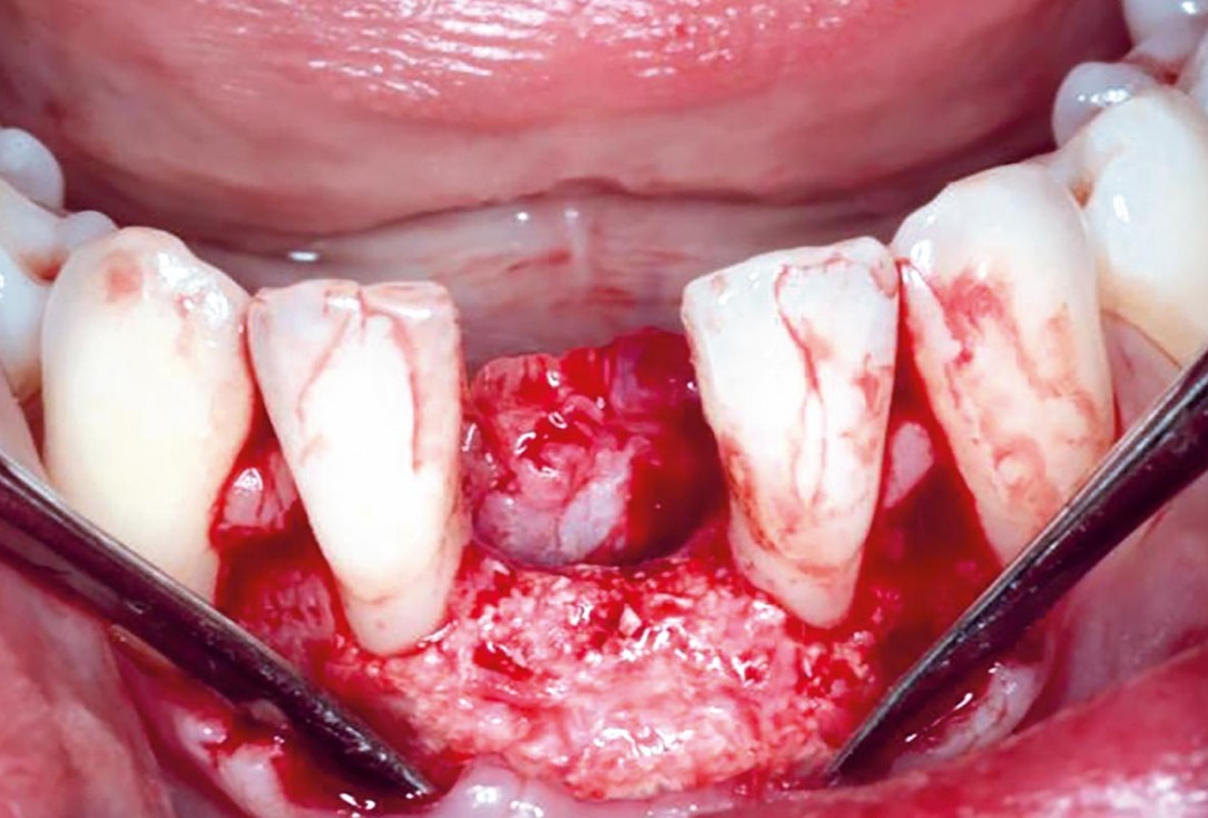 Horizontal GBR in the anterior mandible - Dr. B. Molnar