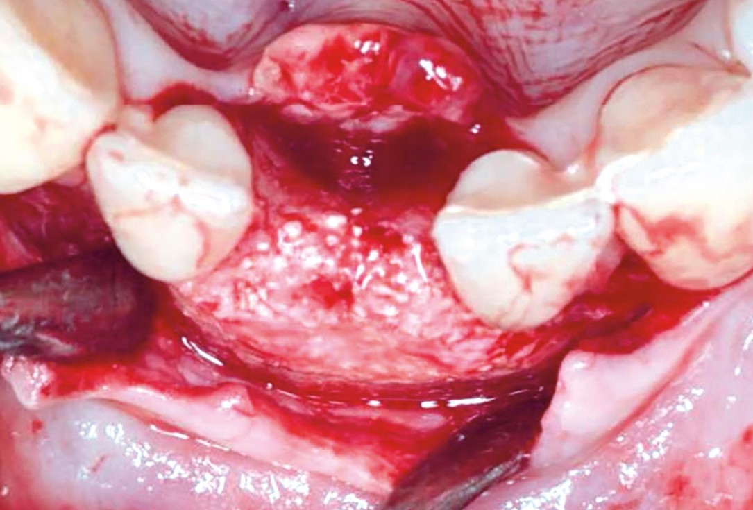 Horizontal GBR in the anterior mandible - Dr. B. Molnar