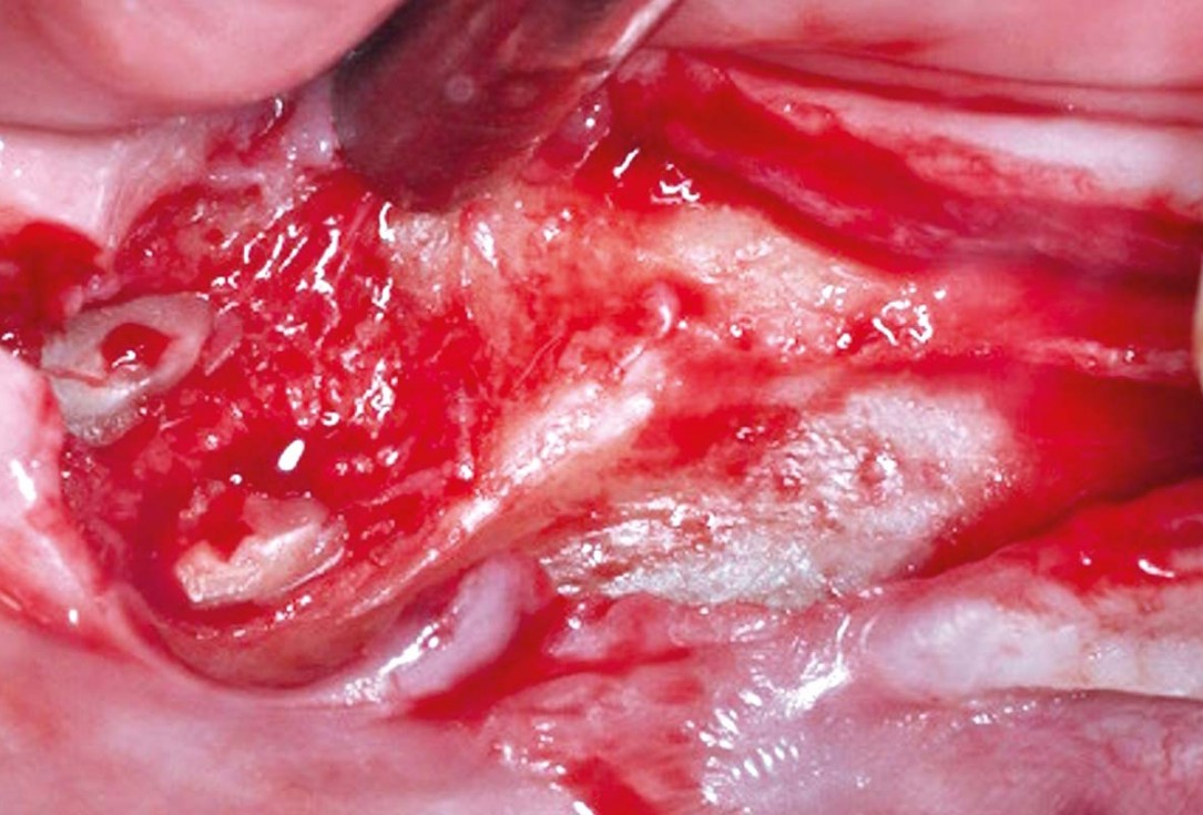 Vertical and horizontal GBR using permamem®, cerabone® and autologous bone - Dr. D. B. Hangyasi