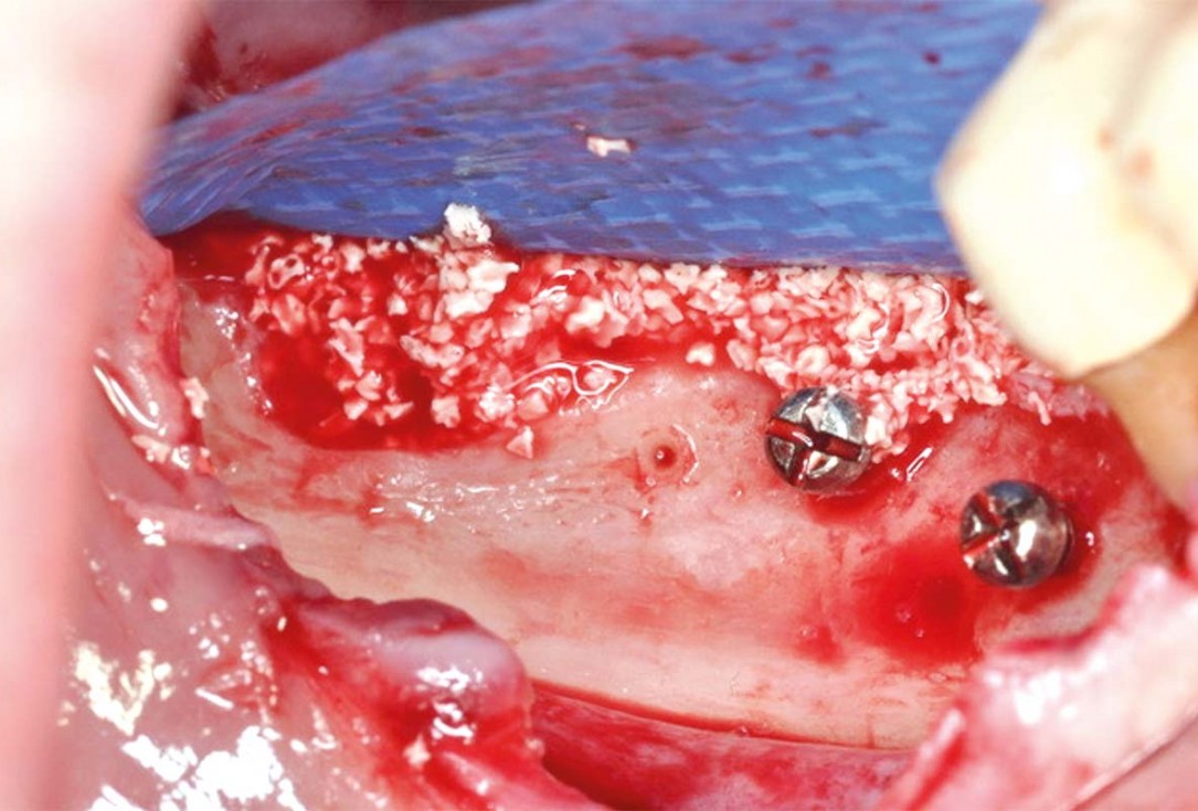 Vertical and horizontal GBR using permamem®, cerabone® and autologous bone - Dr. D. B. Hangyasi