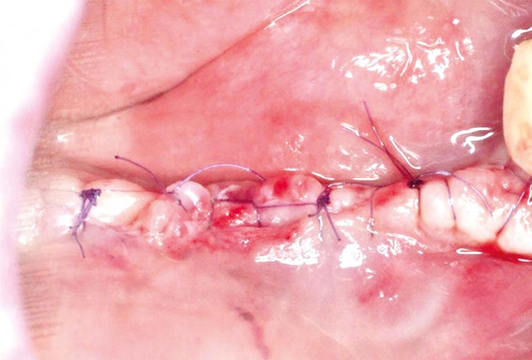 Vertical and horizontal GBR using permamem®, cerabone® and autologous bone - Dr. D. B. Hangyasi