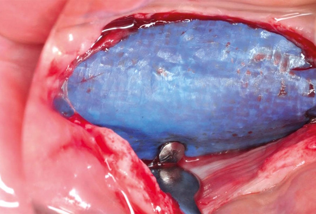 Vertical and horizontal GBR using permamem®, cerabone® and autologous bone - Dr. D. B. Hangyasi