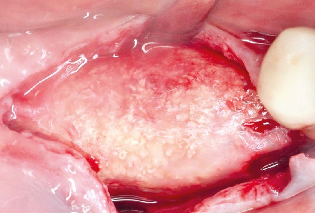 Vertical and horizontal GBR using permamem®, cerabone® and autologous bone - Dr. D. B. Hangyasi