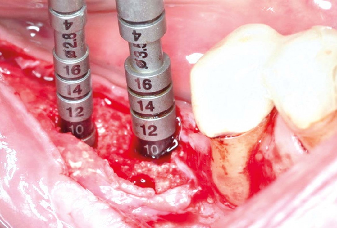 Vertical and horizontal GBR using permamem®, cerabone® and autologous bone - Dr. D. B. Hangyasi