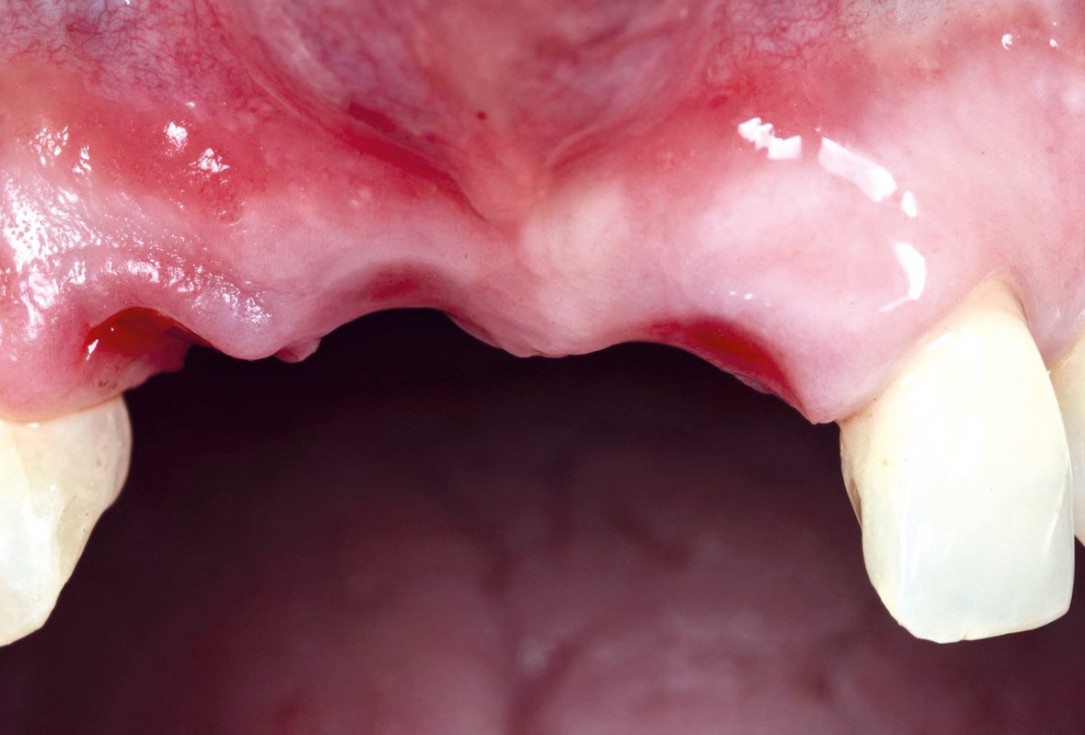 Vertical bone augmentation using tent pole screw-technique - Prof. Dr. S Fickl