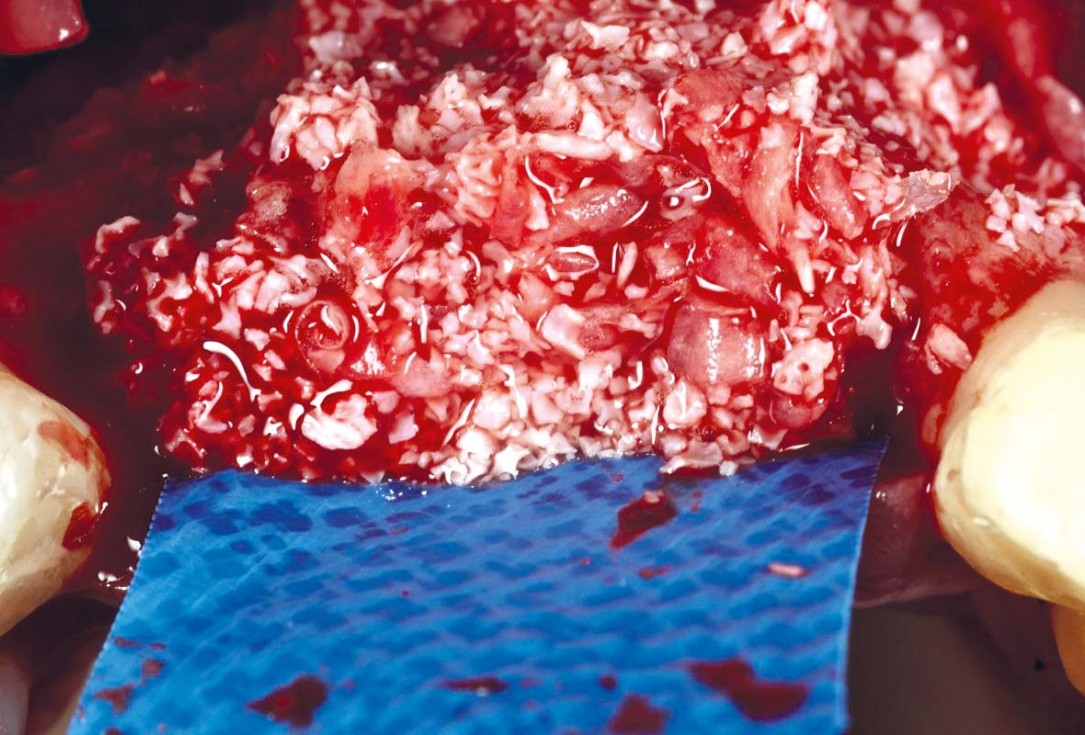 Vertical bone augmentation using tent pole screw-technique - Prof. Dr. S Fickl