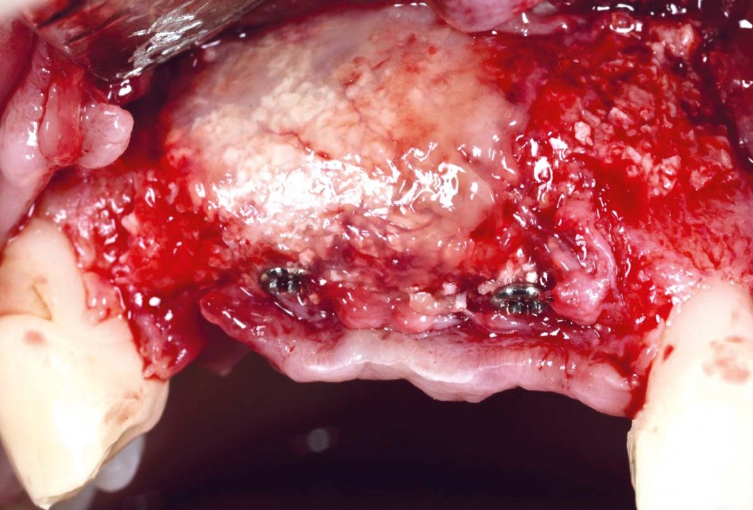 Vertical bone augmentation using tent pole screw-technique - Prof. Dr. S Fickl