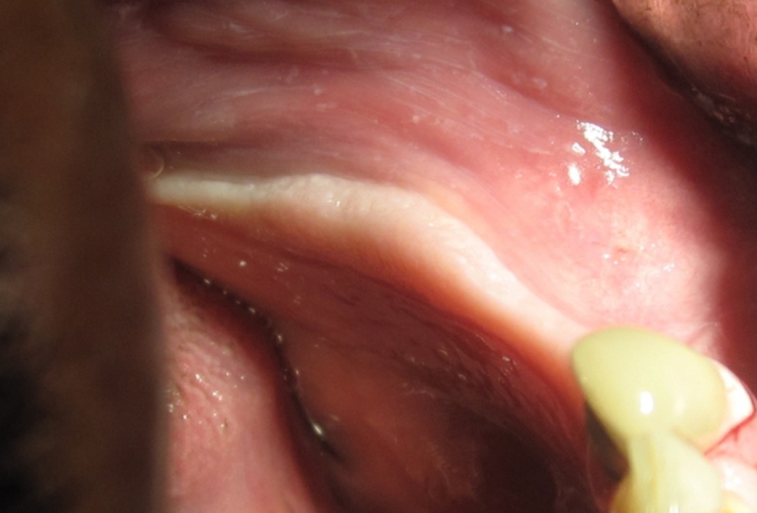 botiss cerabone for ridge splitting and augmentation of an atrophic alveolar ridge - Clinical case by Dr. V. Moshirabadi