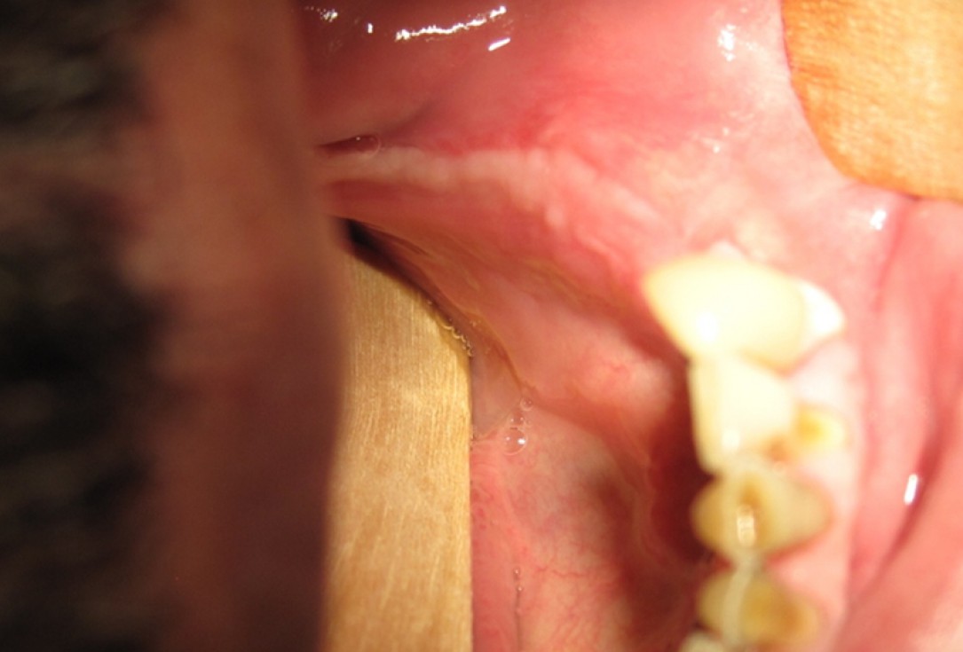 botiss cerabone for ridge splitting and augmentation of an atrophic alveolar ridge - Clinical case by Dr. V. Moshirabadi