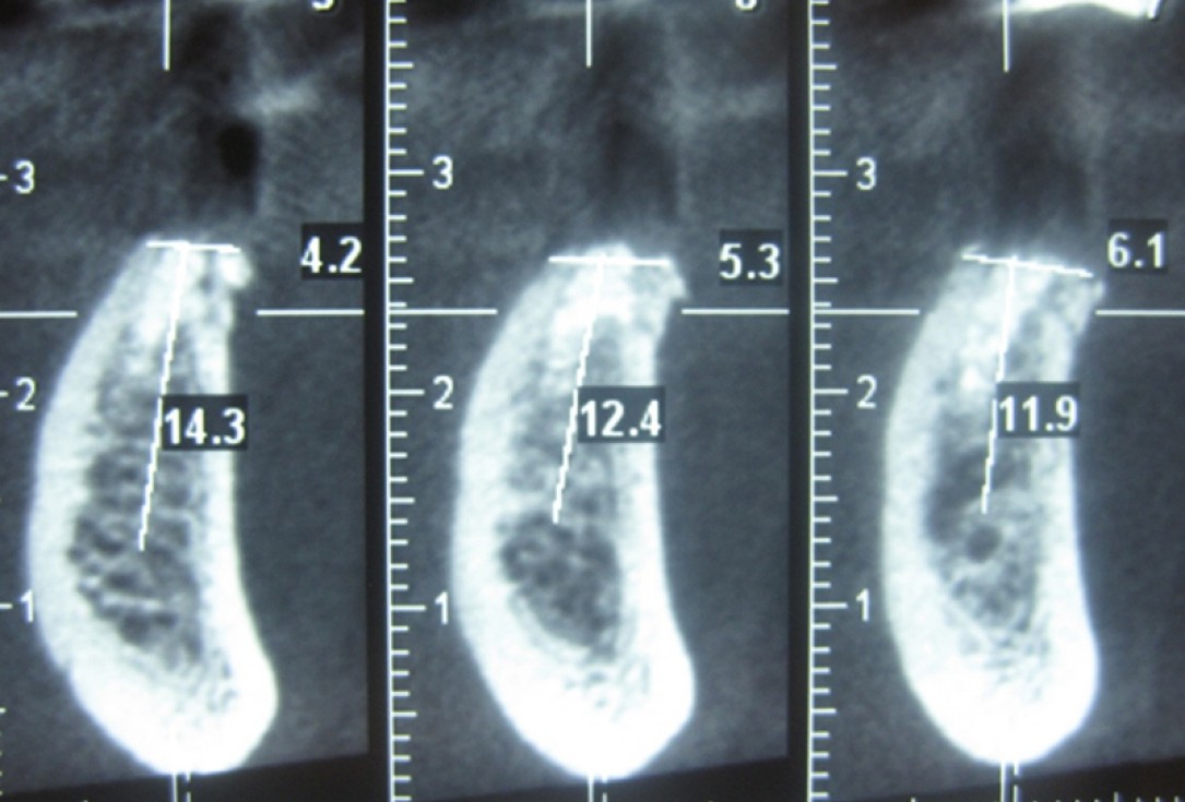 botiss cerabone for ridge splitting and augmentation of an atrophic alveolar ridge - Clinical case by Dr. V. Moshirabadi