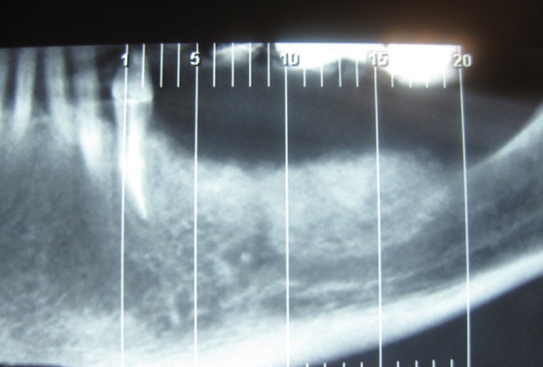 botiss cerabone for ridge splitting and augmentation of an atrophic alveolar ridge - Clinical case by Dr. V. Moshirabadi
