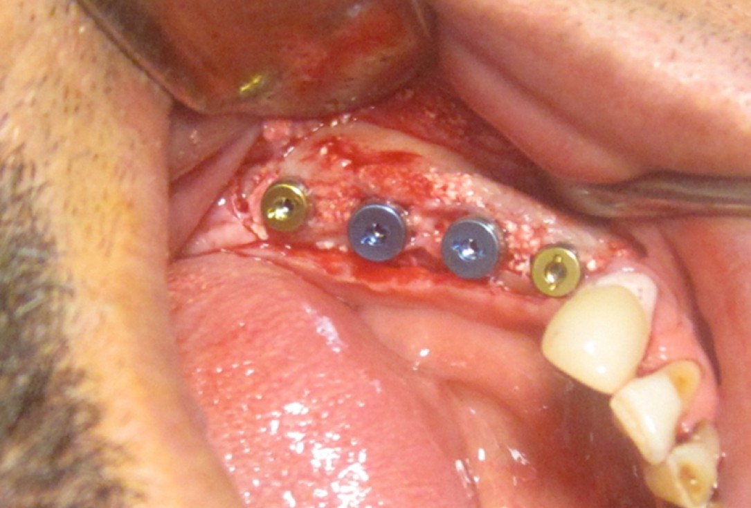 botiss cerabone for ridge splitting and augmentation of an atrophic alveolar ridge - Clinical case by Dr. V. Moshirabadi
